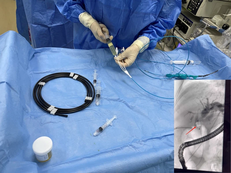 항저우 지역 최고 세 병원 우리의 일회용 돌 검색 풍선 카테터를 사용하여.